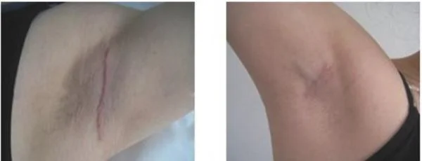 做去腋臭治疗效果怎么样？效果保持时间多久？