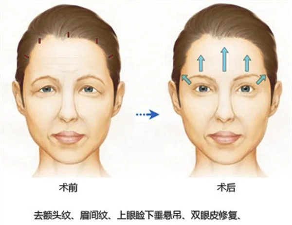 做额颞部除皱去抬头纹价格要多少