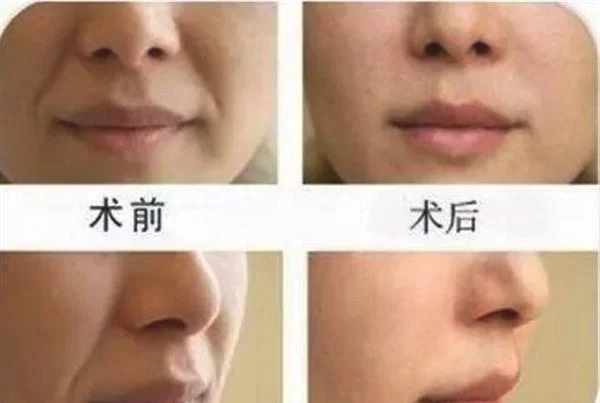 做悬吊除皱去法令纹手术多少钱?