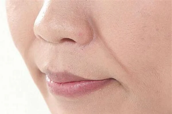 悬吊除皱去法令纹要多少钱？