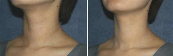 做去颈纹失败修复价格是多少