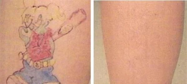 做电灼去纹身手术多少钱?