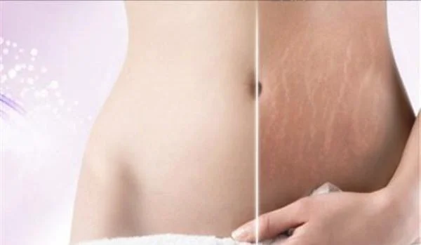 做光子去妊娠纹多少钱