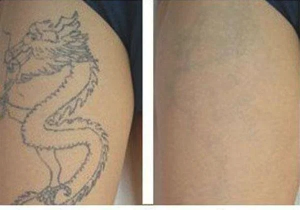 做化学剥脱去纹身治疗效果怎么样?效果保持时间多久?