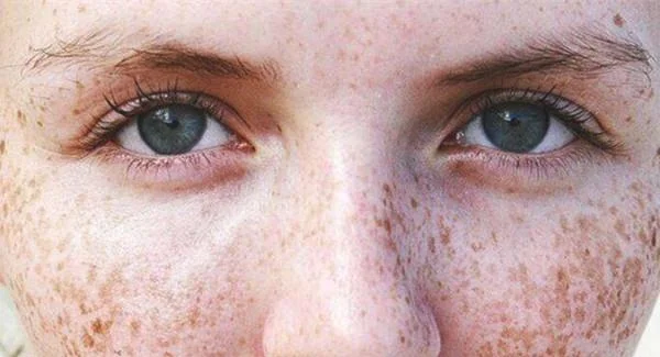 做化学剥脱祛斑手术注意事项是什么?