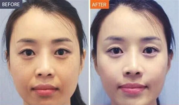 做抗衰老针手术多少钱?