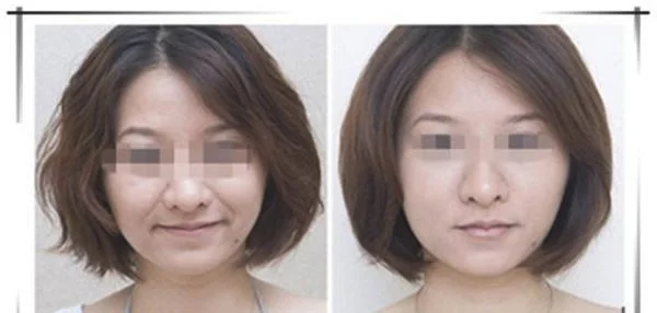 做微晶磨削去法令纹价格