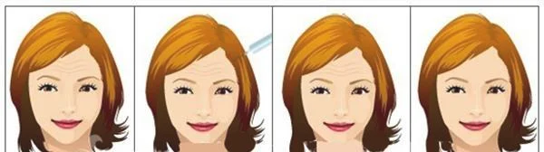 胶原蛋白去抬头纹手术效果好不好？