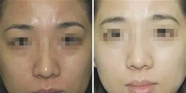 做童颜紧肤术治疗效果怎么样？效果保持时间多久？