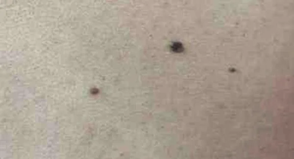 切除手术去黑痣一般维持多长时间?