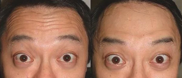 做额颞部除皱去抬头纹费用大概需要多少