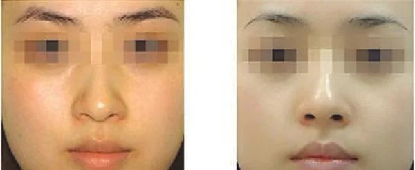 微针嫩肤有什么缺点？