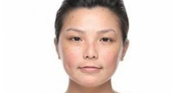 做去色斑手术注意事项是什么？