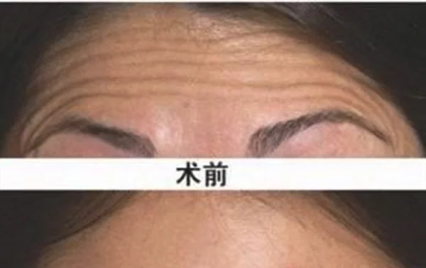 做激光去除抬头纹价格贵不贵