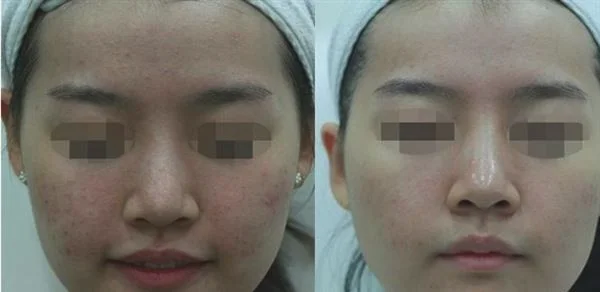 RV极速美塑美肤有副作用吗？