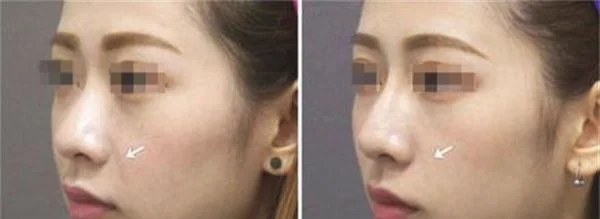 热提拉手术注意事项是什么？