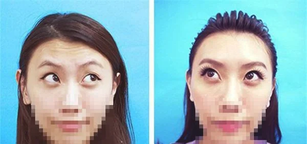 做激光去除抬头纹价格