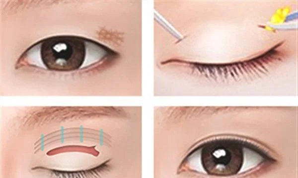 眼睑疤痕修复手术安全吗？