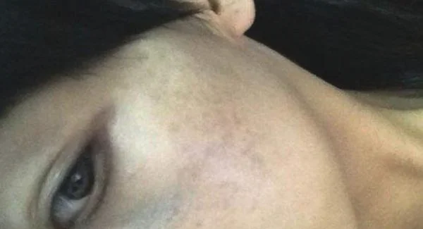 做剥脱治疗去雀斑手术注意事项是什么?