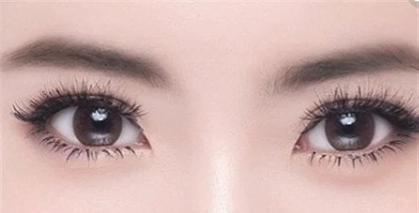 泪痣可以激光去除吗