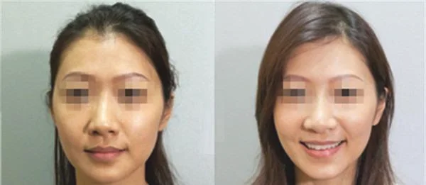 做果酸嫩肤价格