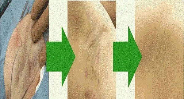 做切除手术来去腋臭价格贵不贵