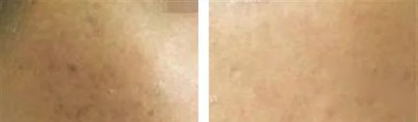 做微晶磨削点痣多少钱