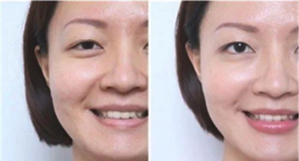 自体脂肪去法令纹适合哪种人?