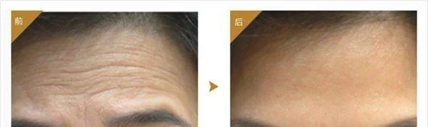爱贝芙去除抬头纹有副作用吗？