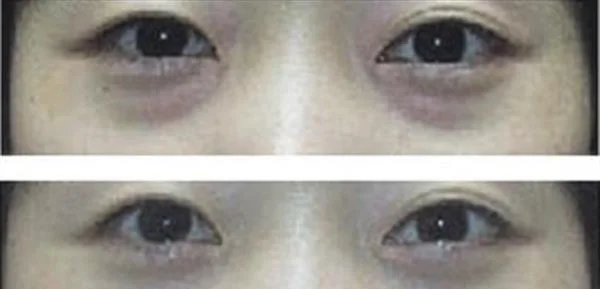 面部年轻化手术术后护理？