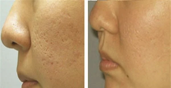 做激光去痘疤价格