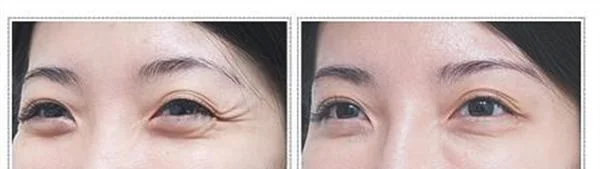 脉冲光去眼角细纹手术效果好不好？