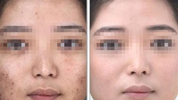 做祛痘印价格贵不贵