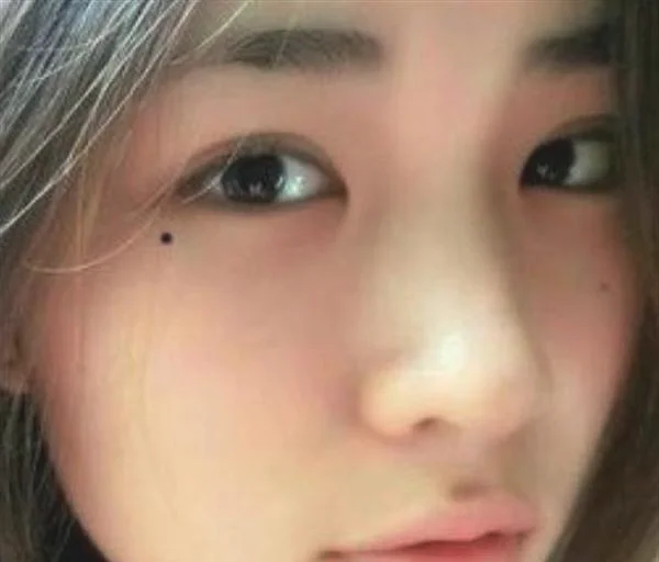 化学剥脱点痣手术术后护理?