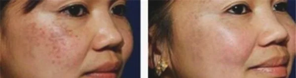 做剥脱治疗去雀斑价格多少钱