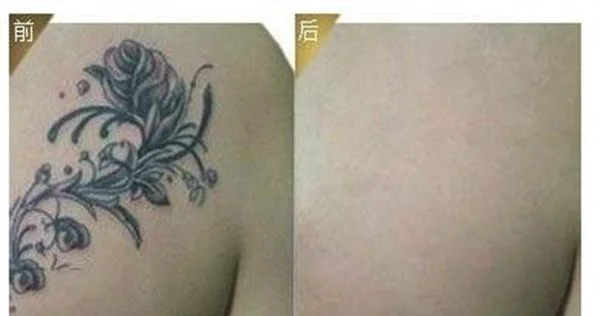 激光洗纹身手术注意事项是什么？