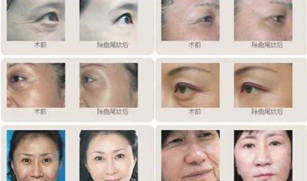 做内窥镜除皱去鱼尾纹治疗效果怎么样？效果保持时间多久？