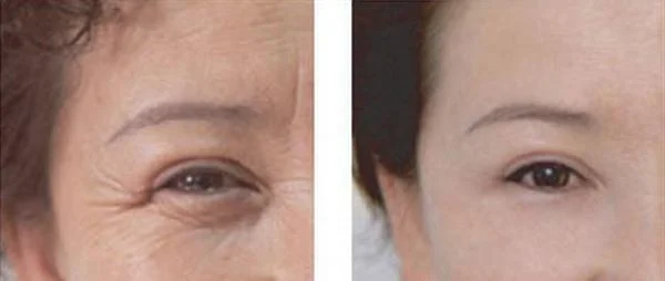 做E光去鱼尾纹手术多少钱？