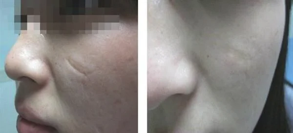 手术疤痕修复手术注意事项是什么？