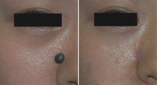 做剥脱治疗去雀斑手术多少钱?