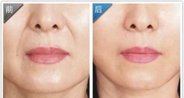 做自体脂肪去法令纹价格
