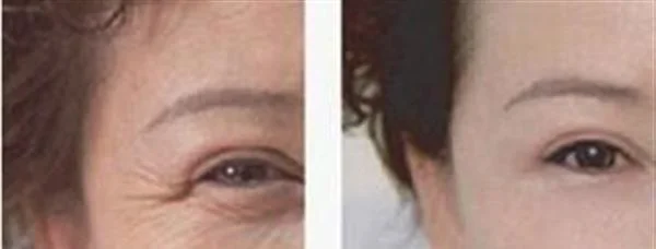 做脉冲光去眼角细纹治疗效果怎么样？效果保持时间多久？