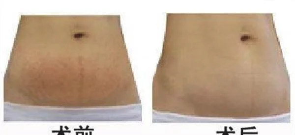 光子去妊娠纹手术术后护理？