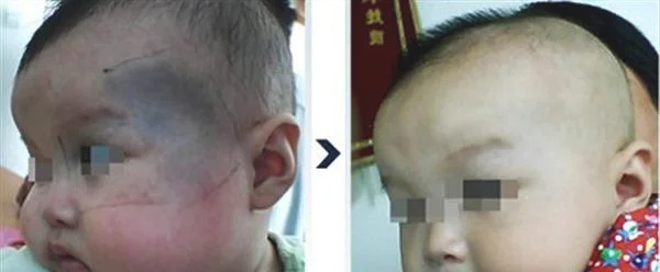 冷冻去除太田痣手术术后护理？