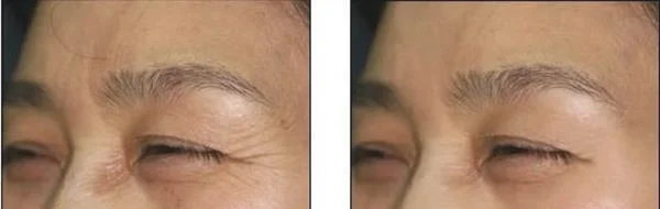 做微晶磨皮去鱼尾纹手术多少钱?