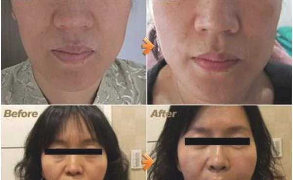 做切开填充治疗痘疤治疗效果怎么样？效果保持时间多久？