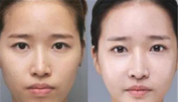 彩光嫩肤有什么缺点？