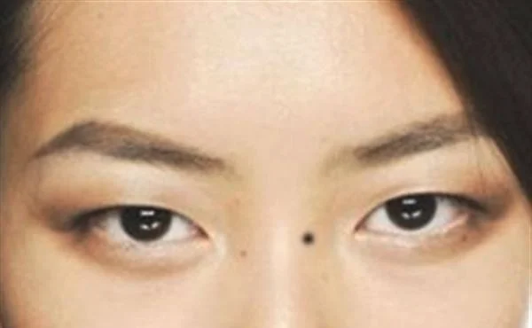 山根有痣好吗