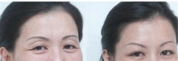 激光去法令纹需要怎么护理?