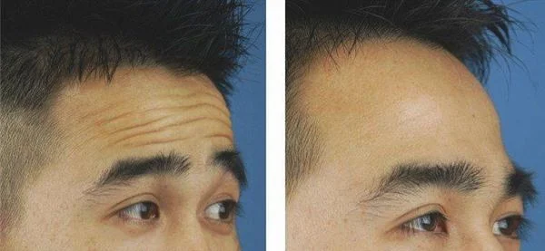 爱贝芙去除抬头纹要多少钱？